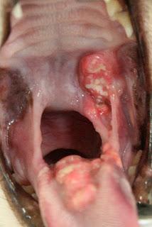 the gingivitis has very painful ulcers